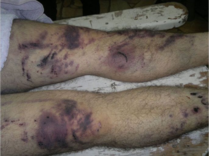 صورة أخرى تظهر آثار التعذيب على جسم احد المعتقلين في فرع الجوية بحماة