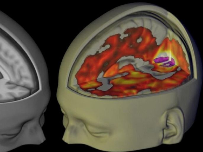 The brains of subjects lying awake with their eyes closed, under a placebo (L) and the drug LSD (R), are seen when being examined using functional MRI, in this handout image from Imperial College London and The Beckley Foundation. Scientists have for the first time scanned the brains of people using LSD and found the psychedelic drug frees the brain to become less compartmentalised and more like the mind of a baby. REUTERS/Imperial College London-The Beckley Foundation/Handout via Reuters ALL ELSE: ATTENTION EDITORS - THIS PICTURE WAS PROVIDED BY A THIRD PARTY. REUTERS IS UNABLE TO INDEPENDENTLY VERIFY THE AUTHENTICITY, CONTENT, LOCATION OR DATE OF THIS IMAGE. FOR EDITORIAL USE ONLY. NOT FOR SALE FOR MARKETING OR ADVERTISING CAMPAIGNS. FOR EDITORIAL USE ONLY. NO RESALES. NO ARCHIVE. THIS PICTURE IS DISTRIBUTED EXACTLY AS RECEIVED BY REUTERS, AS A SERVICE TO CLIENTS. TPX IMAGES OF THE DAY