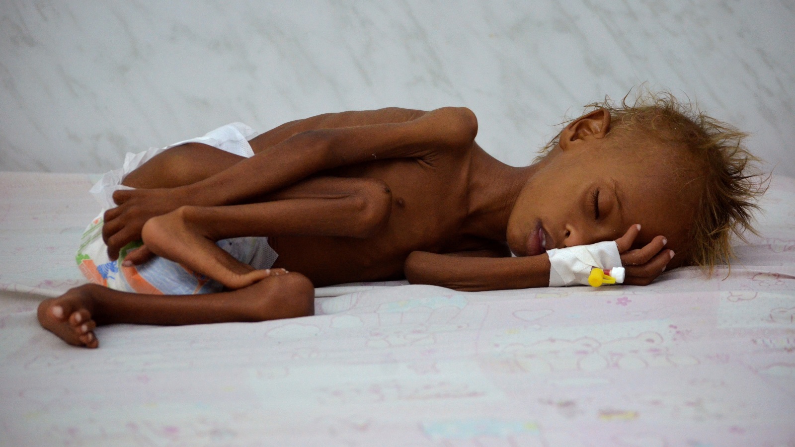 ‪صورة انتشرت للطفل سالم من مدينة الحديدة الذي تعافى بعد خضوعه للعلاج والتغذية‬ (رويترز)