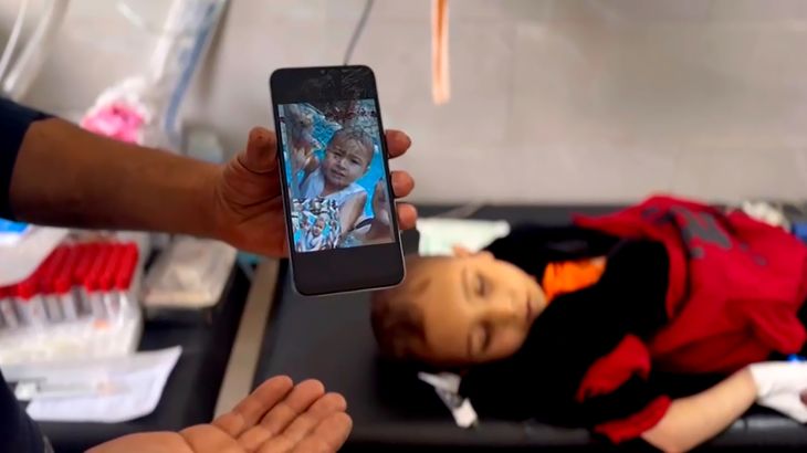 وفاة طفل في مستشفى كمال عدوان شمالي غزة بسبب سوء التغذية