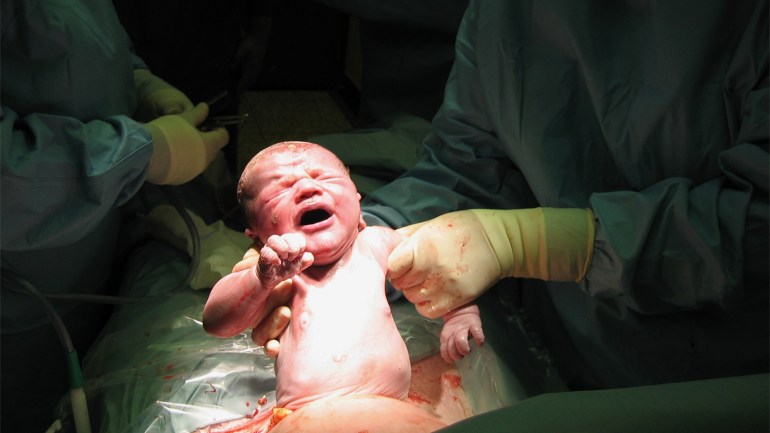 مقترح الولادة القيصرية وانتشارها في مصر