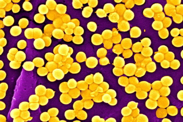 Methicillin Resistant Golden Staph Staphylococcus Aureus Mrsa, Scanning Electron Micrograph Colorized Sem, X 9560, The Line Represents Two Microns. These Bacteria Are Gram Positive Cocci And Facultative Anaerobes That Typically Gather In Clusters, As We See It Here. Golden Staph Is Responsible For Food Poisoning, Cutaneous Infections, Pneumonia, Toxic Shock Syndrome, . . . The Mrsa Is One Of The Most Frequent Multiresistant Bacterial Strains In Healthcare Facilities Hospital Acquired Infections. Golden Staph Staphylococcus Aureus > Staphylococcus > Staphylococcaceae > Bacillales > Firmicutes > Bacterium. This 2005 Scanning Electron Micrograph Sem Depicted Numerous Clumps Of Methicillin Resistant Staphylococcus Aureus Bacteria, Commonly Referred To By The Acronym, Mrsa; Magnified 9560X. Recently Recognized Outbreaks, Or Clusters Of Mrsa In Community Settings Have Been Associated With Strains That Have Some Unique Microbiologic And Genetic Properties, Compared With The Traditional Hospital Based Mrsa Strains, Which Suggests Some Biologic Properties, E. G. , Virulence Factors Like Toxins, May Allow The Community Strains To Spread More Easily, Or Cause More Skin Disease. A Common Strain Named Usa300 0114 Has Caused Many Such Outbreaks In The United States. Methicillin Resistant Staphylococcus Aureus Infections, E. G. , Bloodstream, Pneumonia, Bone Infections, Occur Most Frequently Among Persons In Hospitals And Healthcare Facilities, Including Nursing Homes, And Dialysis Centers. Those Who Acquire A Mrsa Infection Usually Have A Weakened Immune System, However, The Manifestation Of Mrsa Infections That Are Acquired By Otherwise Healthy Individuals, Who Have Not Been Recently Hospitalized, Or Had A Medical Procedure Such As Dialysis, Or Surgery, First Began To Emerged In The Mid To Late 1990's. These Infections In The Community Are Usually Manifested As Minor Skin Infectio (Photo By BSIP/UIG Via Getty Images)