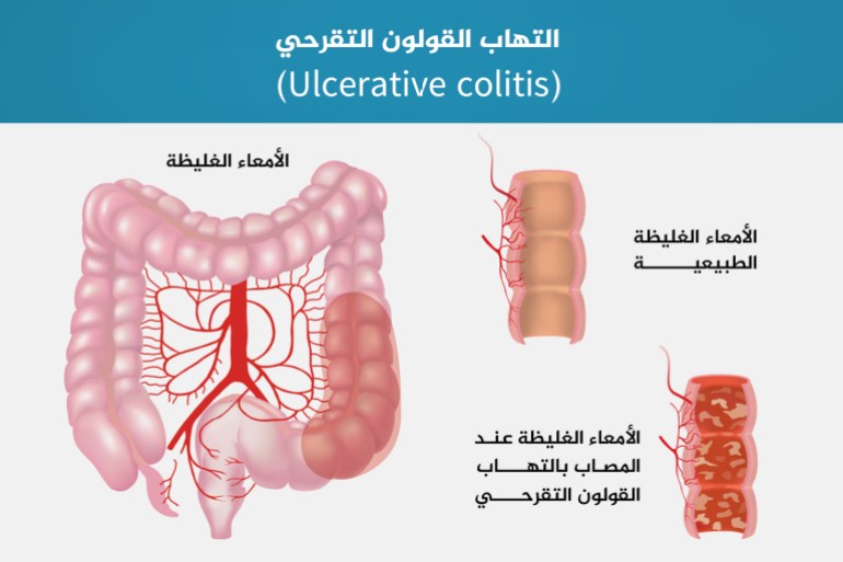 Colite ulcéreuse intestin grêle et épais (Ulcerative colitis)