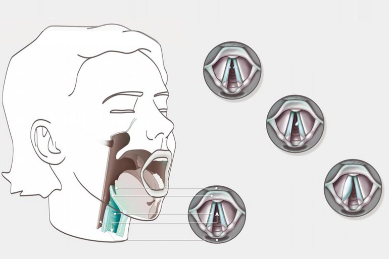 Le dispositif repose sur les mouvements des muscles du larynx (Deutsche Welle)
